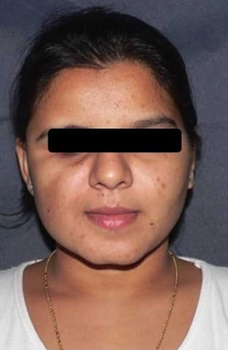 fat-graft-post